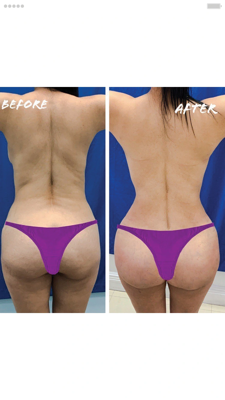 Liposuction and BBL Surgery