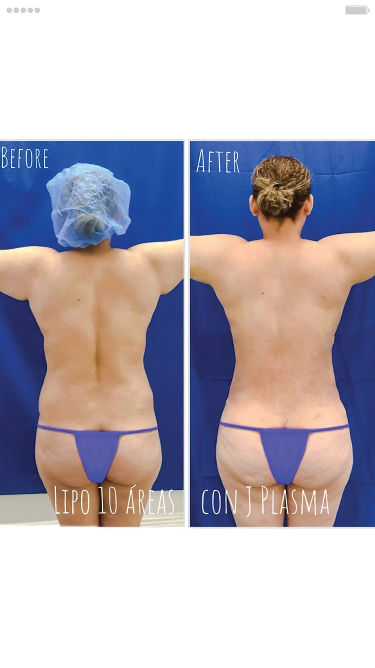 Liposuction and BBL Surgery