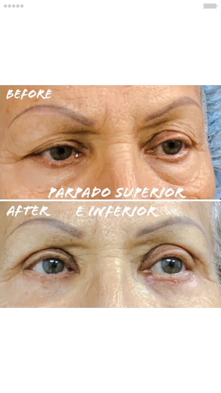 Lower and Upper Eyelid Surgery